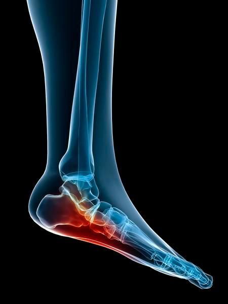 How to Cure Plantar Fasciitis in One Week